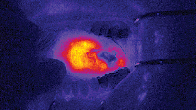 A thermal image showing inflammation or high temperature in a specific area of the body.