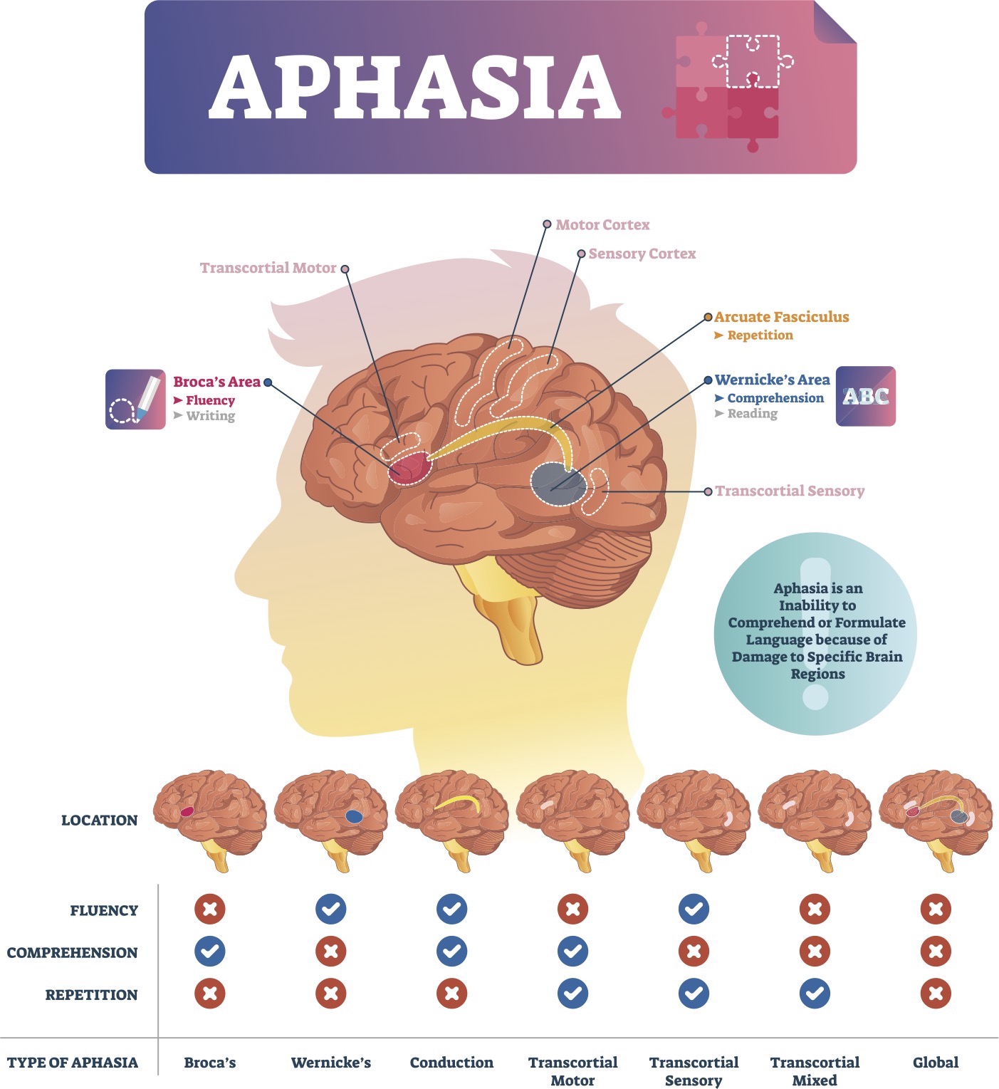 Countering aphasia with targeted speech-language rehab