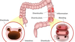 Living with diverticulitis: Get the full scope of symptoms, treatment, and prevention - Featured image