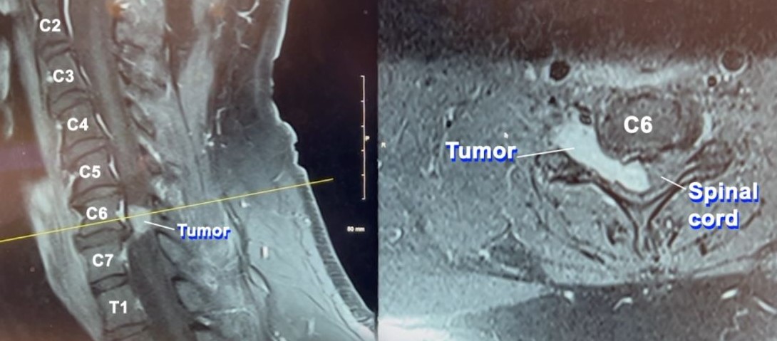 'Every day is a blessing': 11-hour surgery removes dangerous, rare spinal tumor