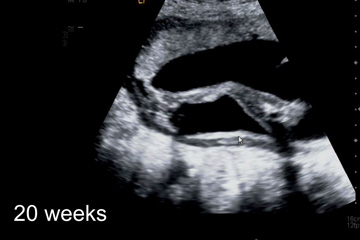 Feeling your baby move during pregnancy