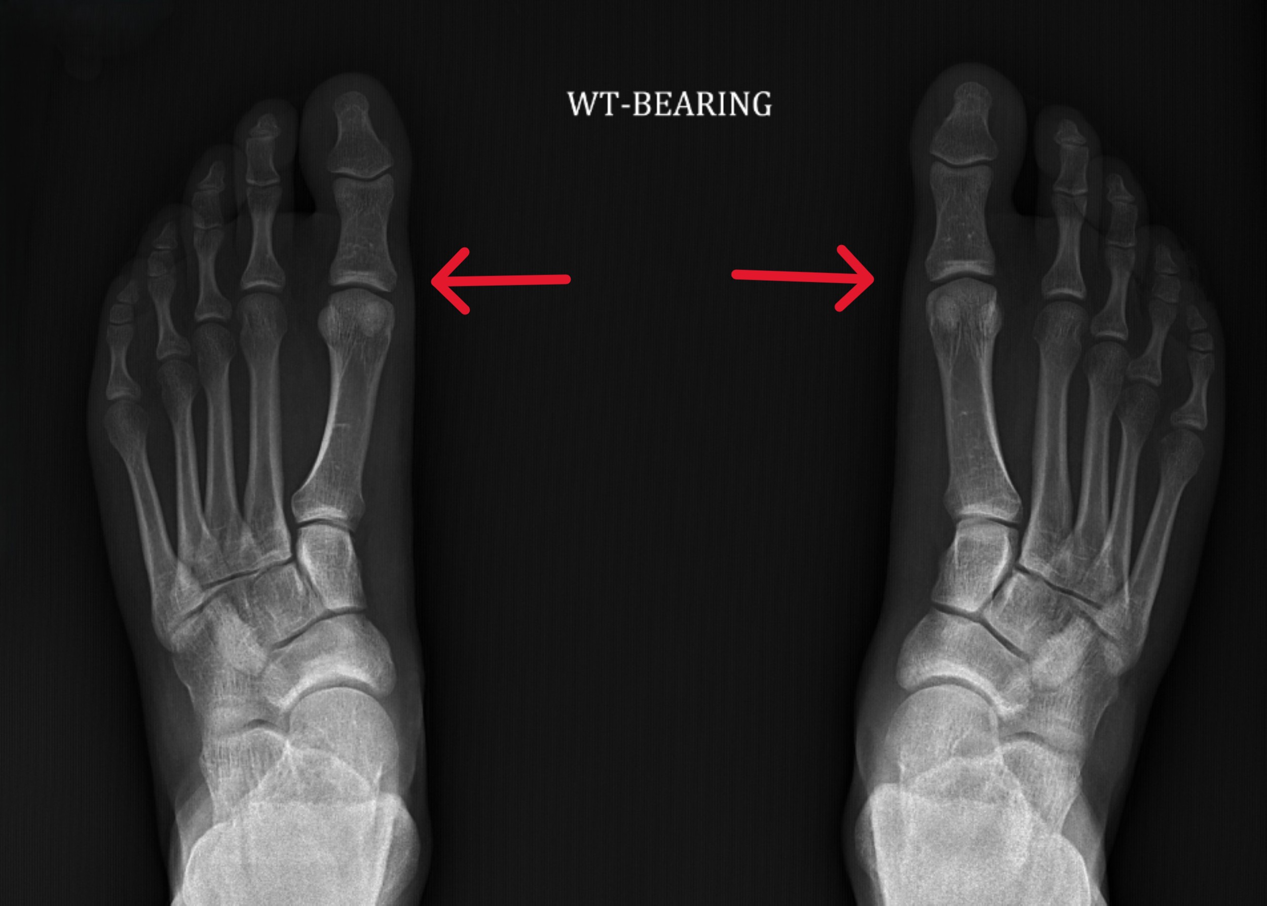 X-ray showing bones in healthy feet with arrows pointing to MTP joint
