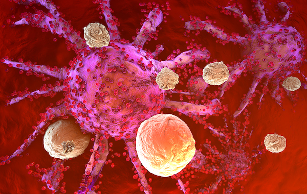 New immunotherapy can prevent kidney cancer recurrence after surgery: Is it right for you?