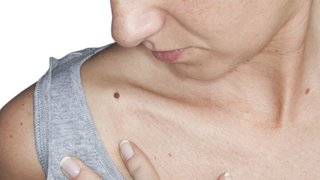 3 skin cancer treatments that might stop melanoma in its tracks - Featured image