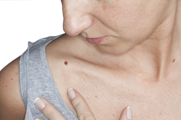 3 skin cancer treatments that might stop melanoma in its tracks