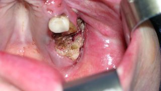 Osteonecrosis of the jaw: Treating bone loss triggered by drugs for osteoporosis, cancer - Featured image