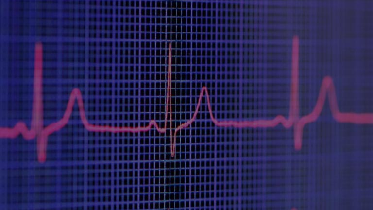 ECG showing heart rhythm.