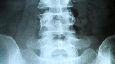 xray of a lower spine