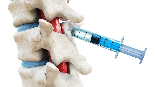 needle being injected into spinal column for pain relief