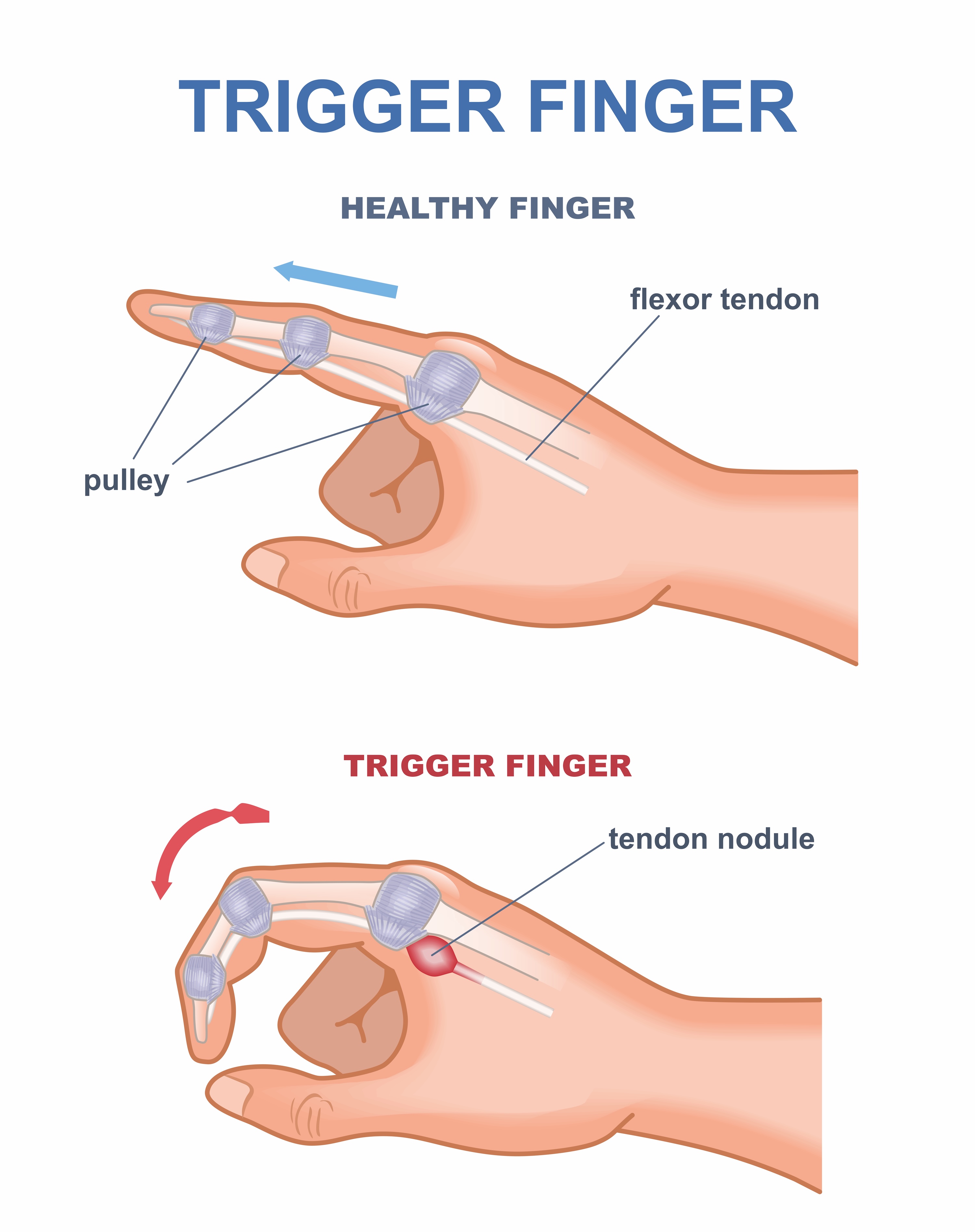 diagram showing healthy finger and trigger finger