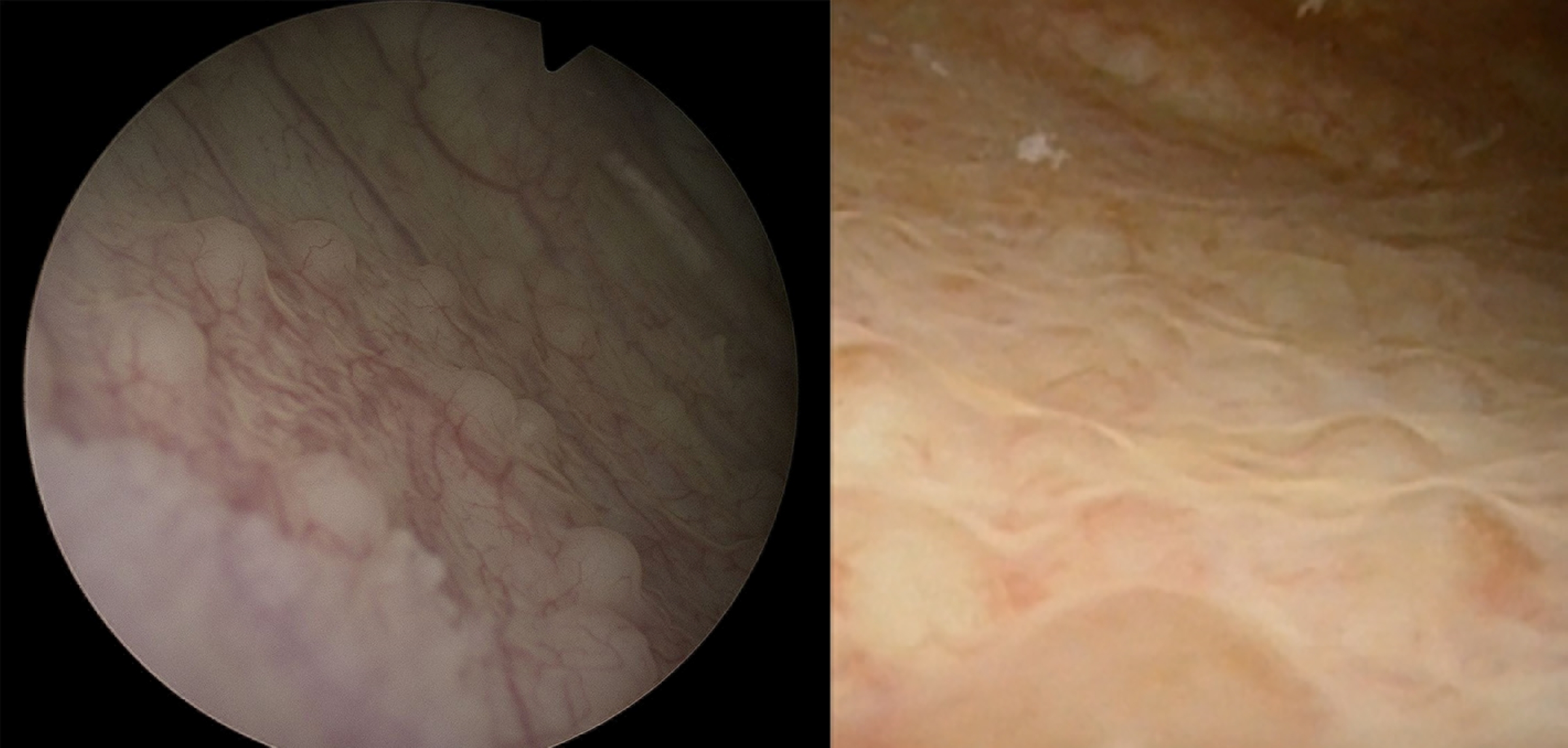 side by side microscopy images showing bladder infection from two patients