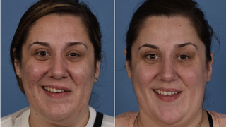 Improving smiles with a new surgical technique to treat facial synkinesis - Featured image