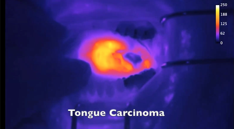 Fluorescent nanoprobe lights the way to reducing spread of cancer cells