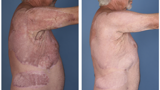 Laser therapy smooths and flattens raised scars after burn injury or surgery - Featured image