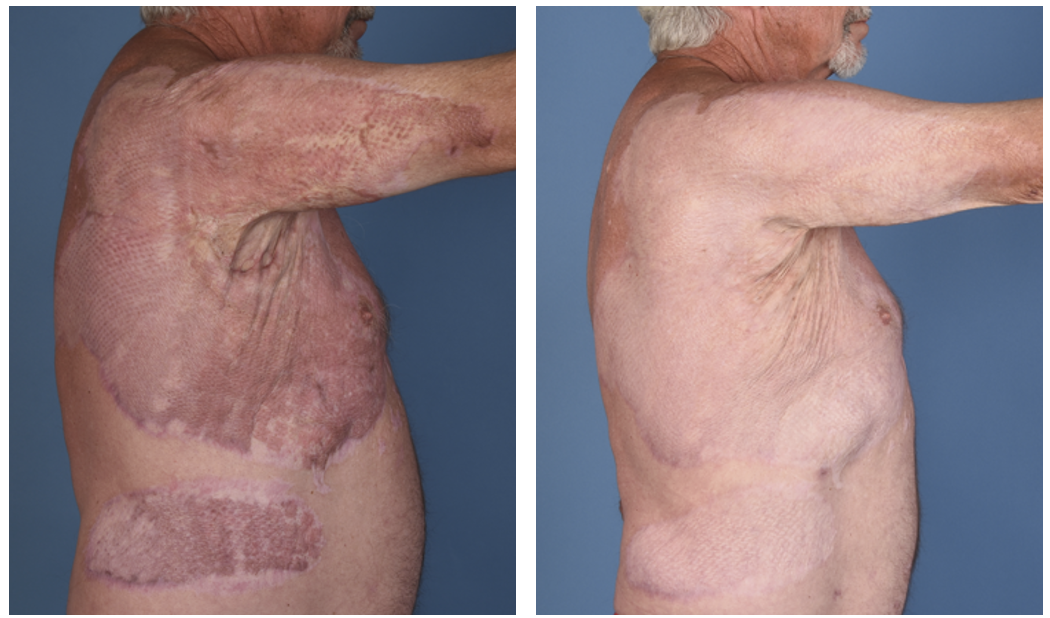 Laser therapy smooths and flattens raised scars after burn injury or surgery