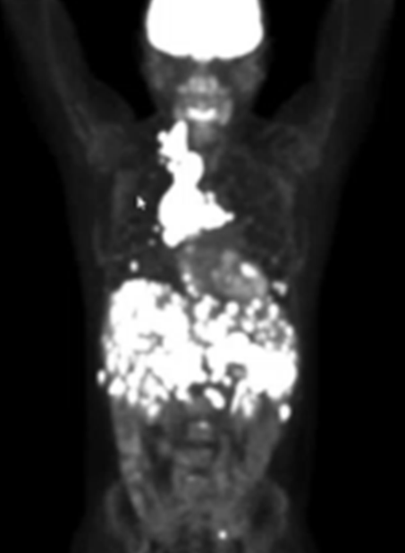 medical scan showing cancer in patient Erik Torres